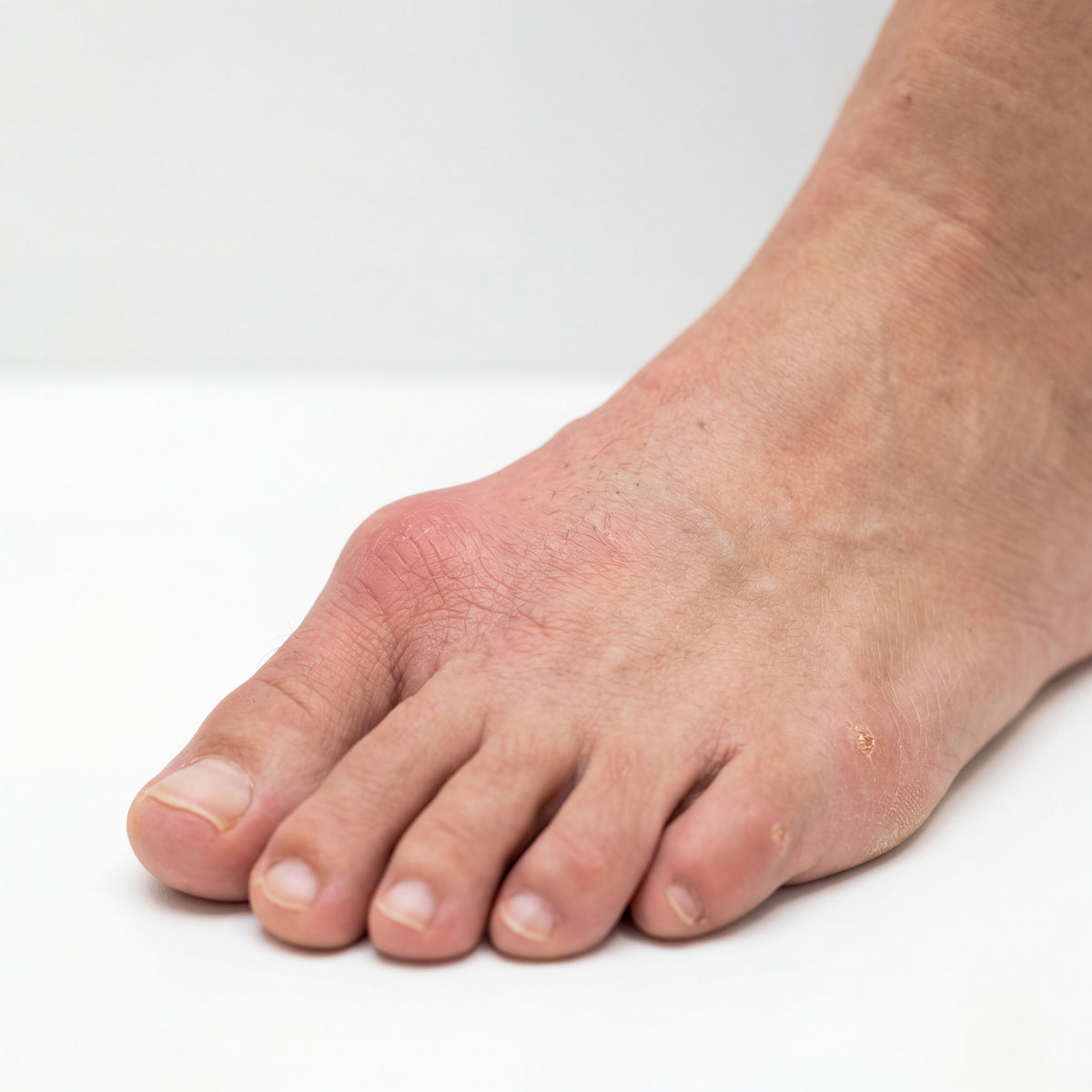 Ohne OrthoStep™